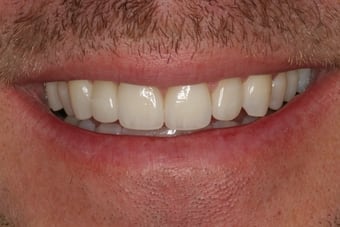 Dental-crown-after-382033
