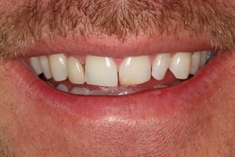Dental-crown-before-382033