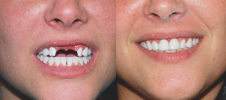 Имплантация 2 зубов