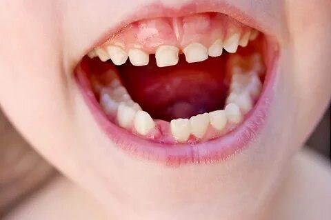 Пластика уздечки языка и губы у детей