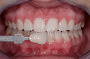 Zoom-Whitening-after-3736105-2838711