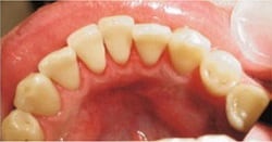 posle-gigieny-zubnoy-kamen