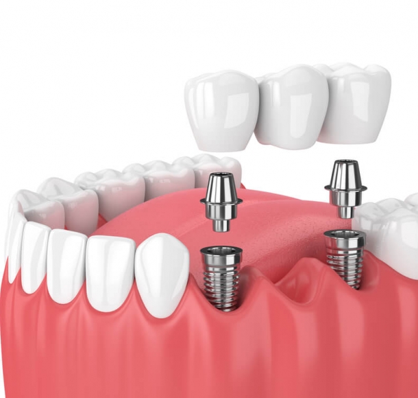Имплантация зубов нижней челюсти