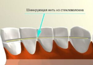 Шинирование зубов