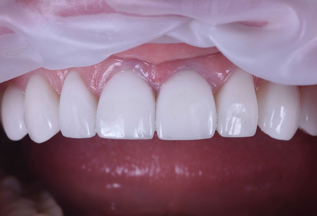 Виниры на передние зубы — что это такое?