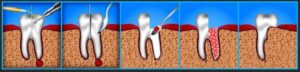 Удаление коренного зуба